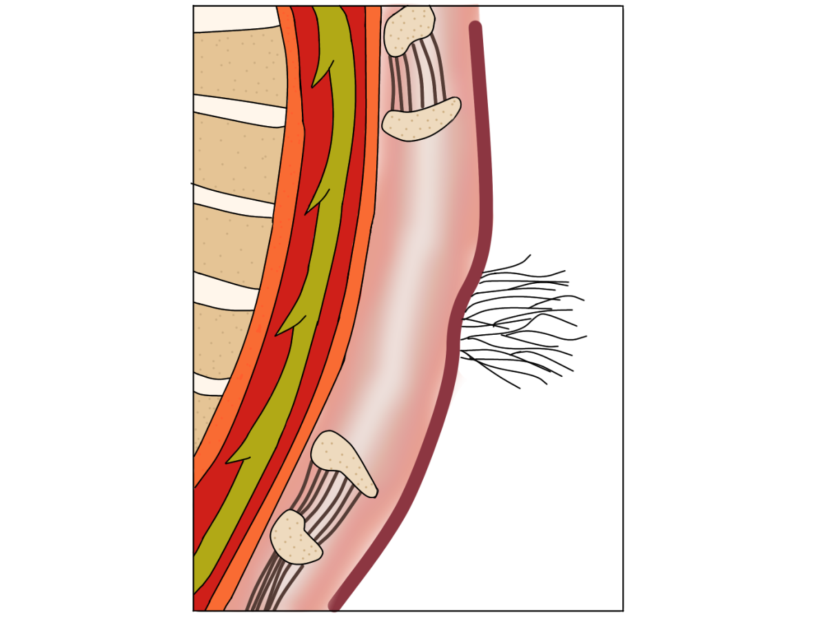 Spina bifida nascosta